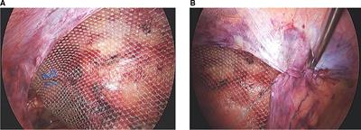 <mark class="highlighted">Clinical Data Analysis</mark> for Treatment of Adult Inguinal Hernia by TAPP or TEP